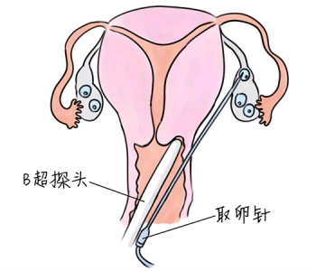 小儿退烧推拿手法 5种重庆捐卵宝宝退烧按摩方法